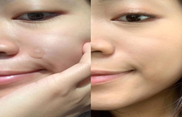 Pimple Patch Before Or After Skincare